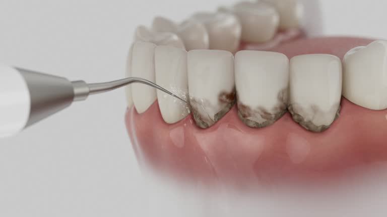 Reliable Wisdom Tooth Removal contractor in Plains, TX by Smile Center Dentistry